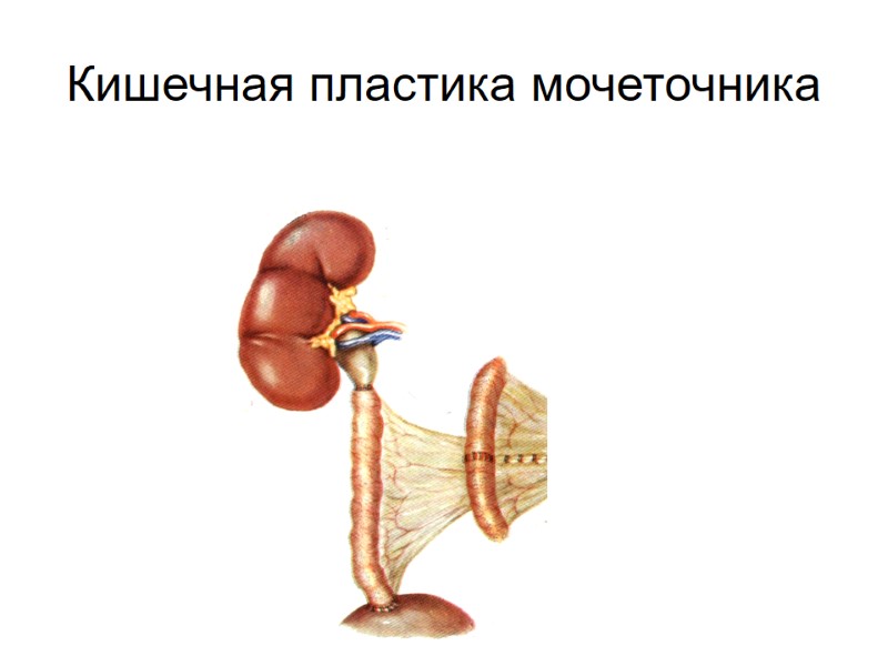 Кишечная пластика мочеточника